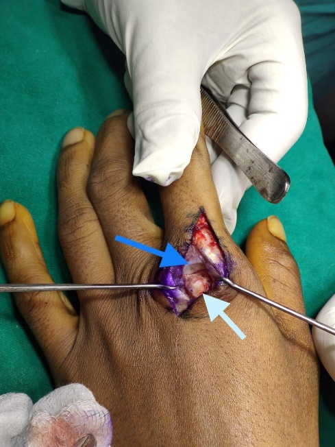 Intra-operative picture showing Osteochondral fragment (white arrow) and Articular cartilage of proximal phalynx (blue arrow)
