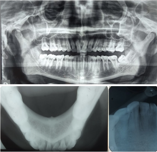 OPG, Occlusal radiograph of mandible and .IOPAR (41,42)