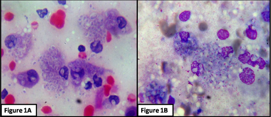 Photomicrographs showing histiocytes studded with intracellular Histoplasma capsulatum surrounded by clear halo or pseudocapsule.