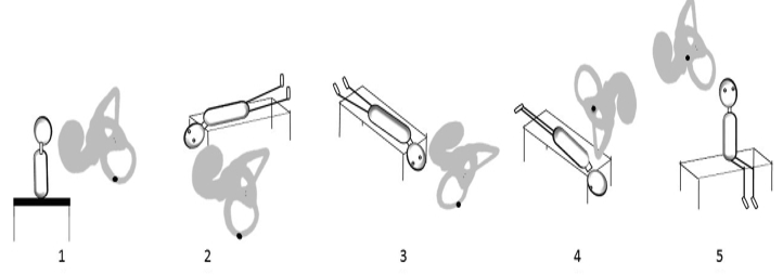 Position of otoconia during Epley’s maneuver 6