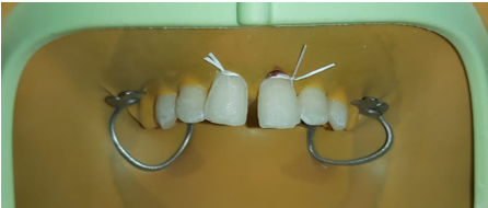 Maxillary anterior teeth were isolated with a rubber dam and retraction was done using dental floss. Window preparation was done on the labial surface of the tooth.