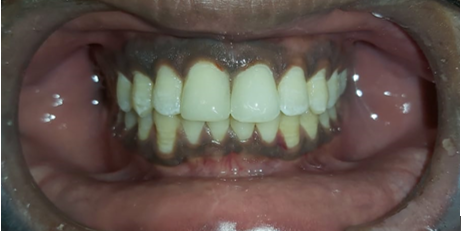 Postoperative view after the diastema closure with direct composite restoration.