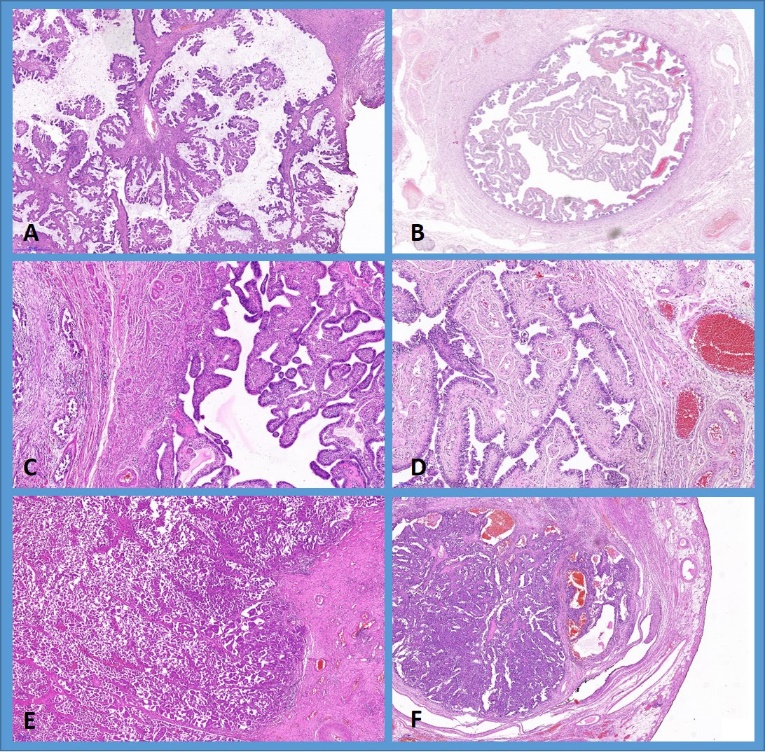 Microphotographs of ovarian tumors and matched fallopian tubes. Serous borderline tumor (A) with matched normal fallopian tube (B), low grade serous carcinoma (C) with matched fallopian tube with serous intraepithelial lesion (D) and high grade serous ovarian cancer (E) with matched fallopian tube carcinoma in situ (F). H&E, x 100
