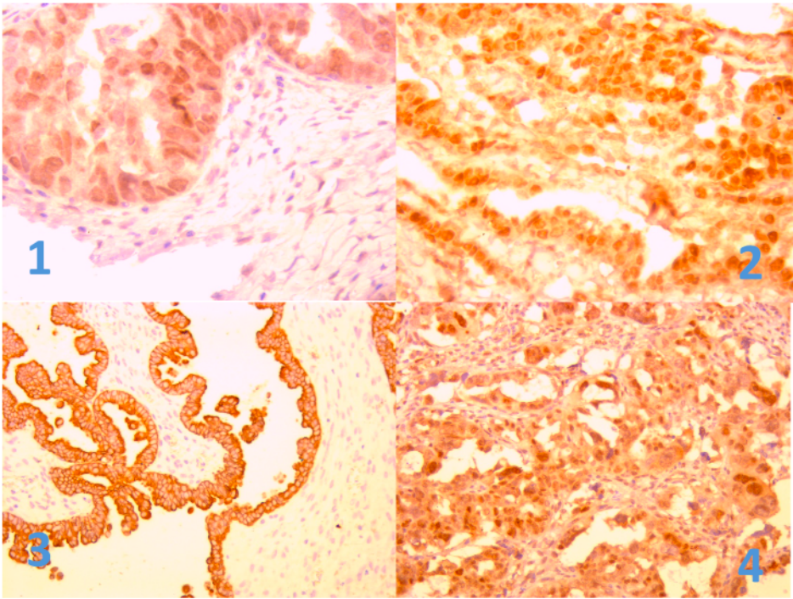 Microphotographs of ovarian tumors and matched fallopian tubes. IHC: 1): P53 expression in Fallopian tube; 2): P53 expression in ovarian cancer; 3): CD44 expression in Fallopian tube; 4): CD44 expression in ovarian cancer