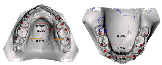Scanned maxillary and mandibular models.
