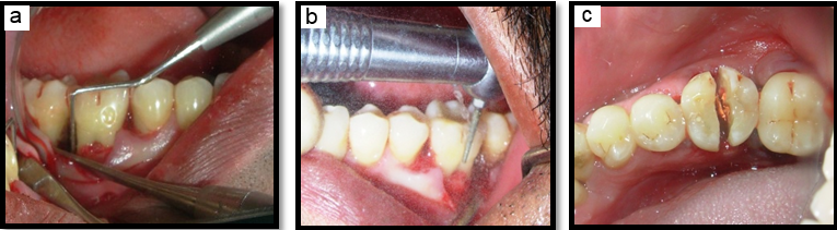 a,b,c: Surgical site 35-37 region: Mucoperiosteal flap raised, 36 being split into a mesial and distal half with a long straight fissure bur.