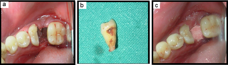 a,b,c: Extraction of distal root & socket preservation