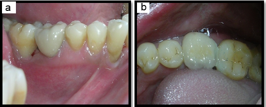 a,b: Prosthetic rehabilitation of 36 with resin bonded restoration