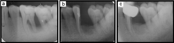 a,b,c: Pre & post treatment comparative IOPA radiographs of 36