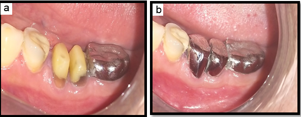 Post-bicuspidisation post & Core followed by prosthetic rehabilitation 36. 