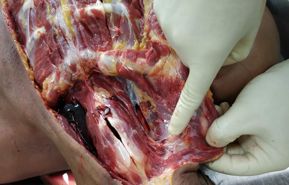 Showing neck dissection findings