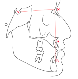 Schematic representation of angle SNA, SNB and ANB