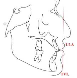 Schematic representation of measurement of projection of upper lip to true vertical line or upper lip anterior (ULA)