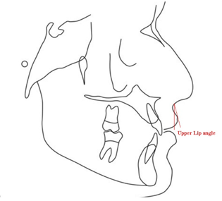 Schematic representation of measurement of upper lip angle
