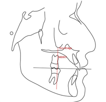 Schematic measurement of distance of key ridgeto mesiobuccal root of permanent maxillary first molar