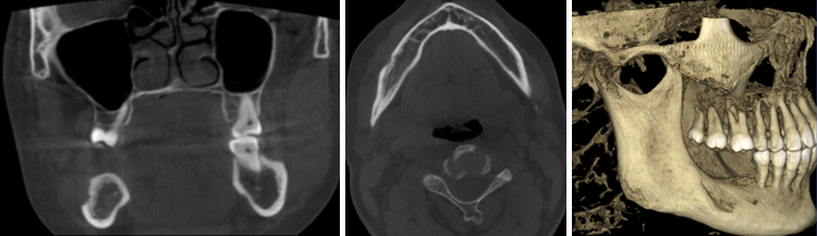 CBCT revealed destructive area on right posterior area of the mandible. The buccal cortex was lost with the hypodense area of irregular bony erosions in the molar area extending deep up to the mandibular canal.