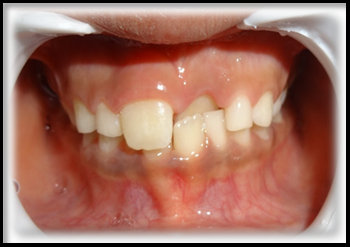 Anterior dentalcrossbite