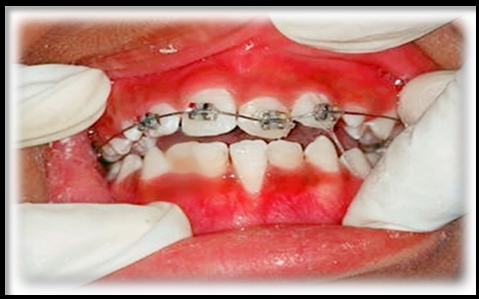 Single arch 2 x 4 interceptive ortho appliance