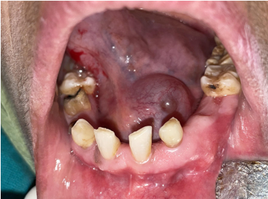 Intraoral photograph showing swelling on left side of floor of mouth