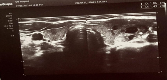 Ultrasound of thyroid