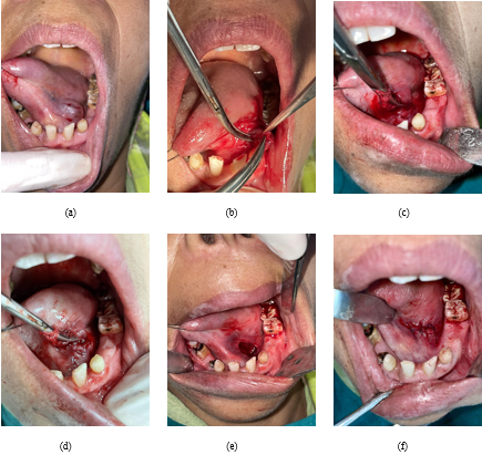 Figures a, b, c, d, e, f depicts the procedure of surgical excision of Ranula under LA