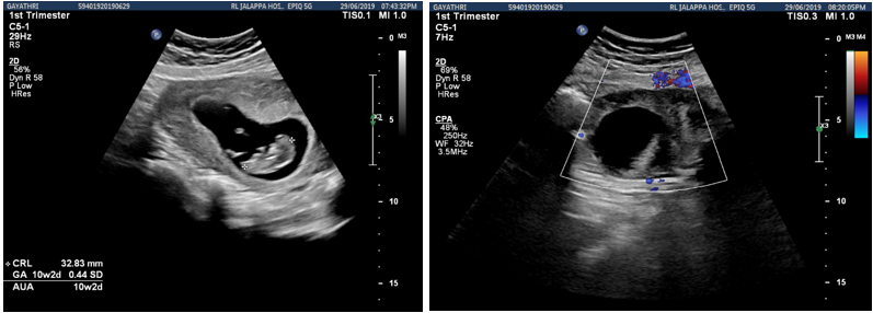 Single live intrauterine gestation with ovarian torsion