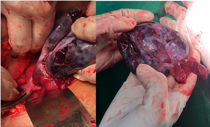 Intraoperative view of necrosed ovary