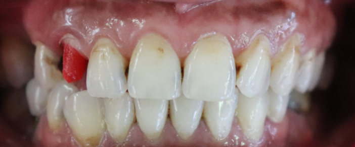 Custom post n core with tooth preparation