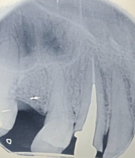Radiograph showing zirconia post in prepared post space (try-in)
