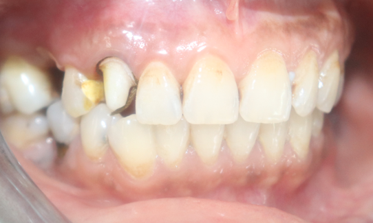 Zirconia postluted and gingival retraction for final impression 