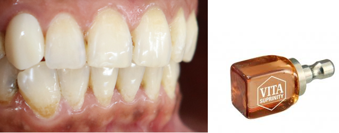 CAD-CAM (Suprinity) all ceramic restoration in situ