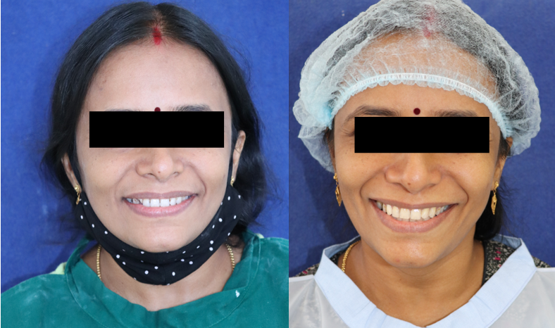 Pre & Post treatment comparison