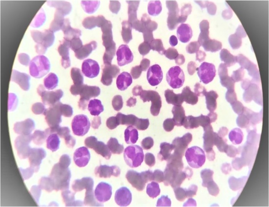 H&E stain AML(oil immersion)