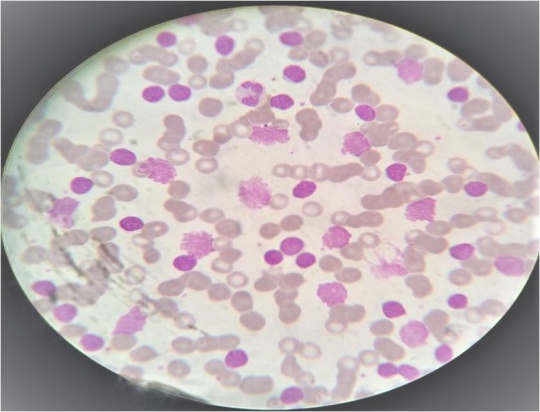 H&E stain CLL(oil immersion)