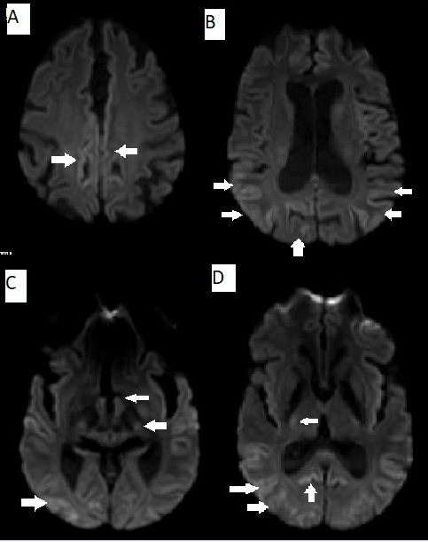 MRI DWI images showing areas of restricted diffusion involving A. medial frontal cortex B. parieto-occipital cortex bilaterally C. periaqueductal grey matter, thalami and right occipital lobe D. thalami, parieto-occipital cortex and corpus callosum