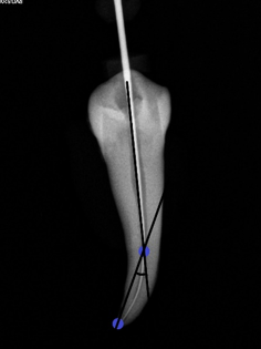 Schneider’s method used to detect canal curvature.