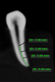 Measurements taken from the apex- 3mm, 5mm, 7mm.