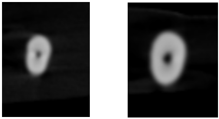 Pre and post operative image at 5 mm from the apex – Trunatomy