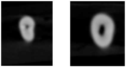 Pre and post operative image at 5 mm from the apex – ProTaper gold