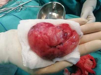 Intra-operative image of left lump with bosselated external surface
