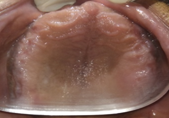 Maxillary complete edentulous arch