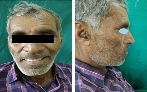 Post-operative extra-oral photograph showing augmented cheeks