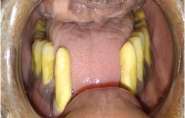 Mandibular partially edentulous arch