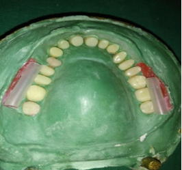 Assembly until self cure plug sets and Wax-strip is later carefully removed