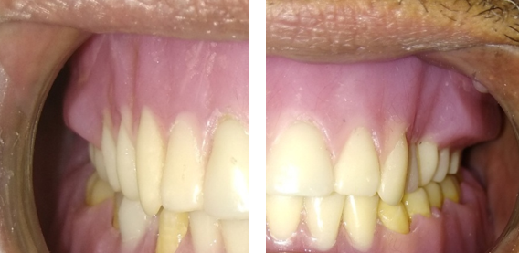 Final prosthesis with hollow cheek plumpers of right and left side
