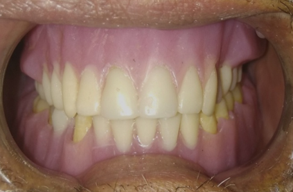Post-operative intra-oral photograph
