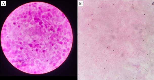 A: Gram staining of the pus sample, B: Gram negative bacilli observed