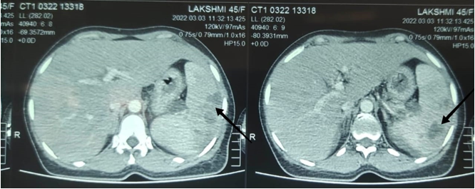 CT Abdomen showing multiple well defined peripheral enhancing lesion noted involving spleen-largest measuring 4*3 cm in inferior pole showing multiple splenic abscesses.