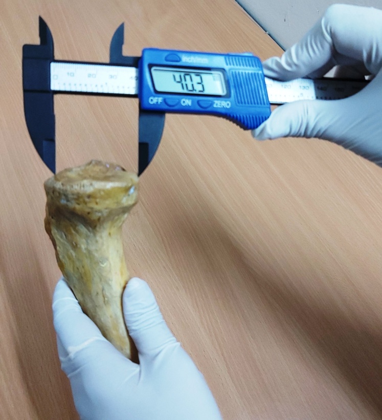 Measurement of medial condyle A-Pdiameter