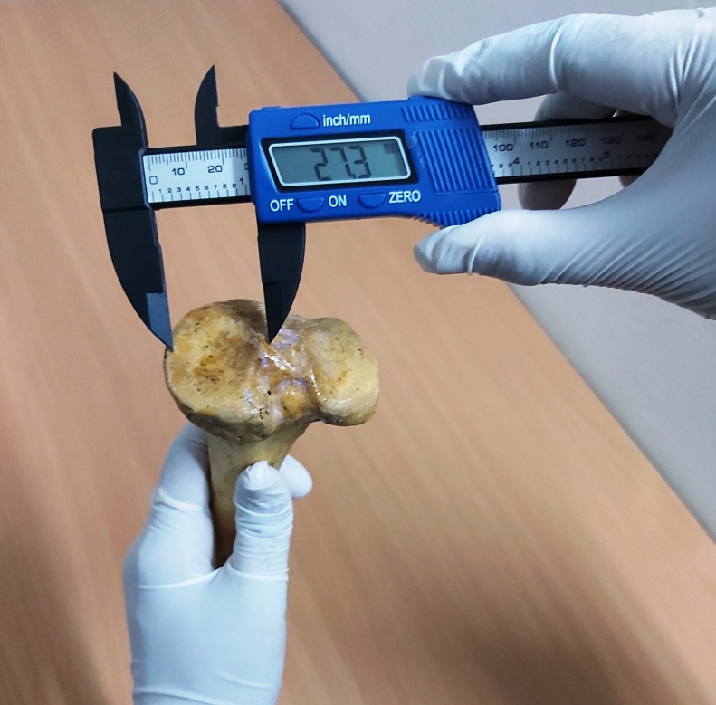 Measurement of medial condyle T-D diameter